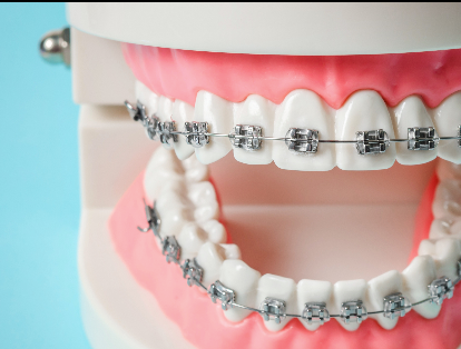 When to go For Dental Braces: Know Here